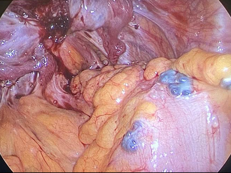 Endometriose Intestinal
