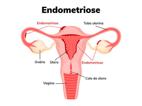Endometriose