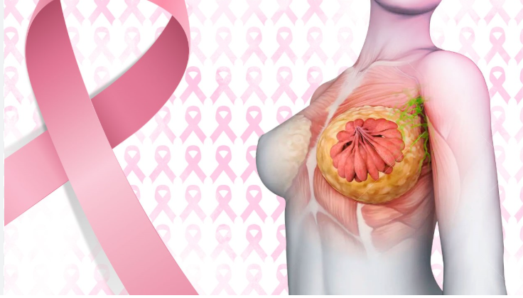 Quimioterapia no Tratamento do Câncer de Mama