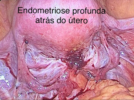 Locais mais acometidos pela endometriose