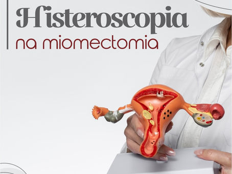 Histeroscopia na Miomectomia