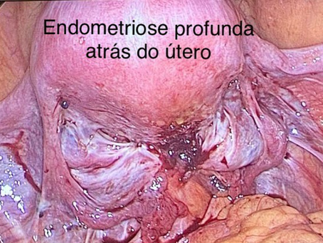 Locais mais acometidos pela endometriose