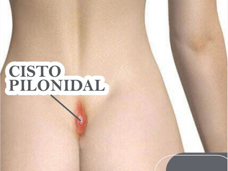 Cisto Pilonidal