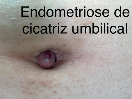 Endometriose de cicatriz umbilical