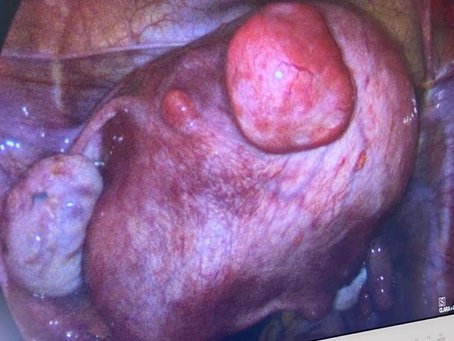 Diagnóstico dos miomas uterinos