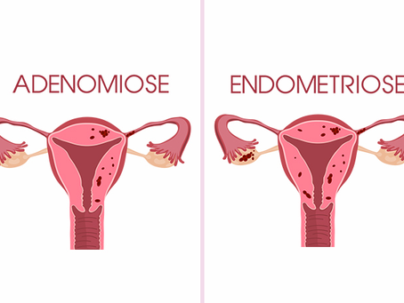 Endometriose e Adenomiose são a mesma coisa?