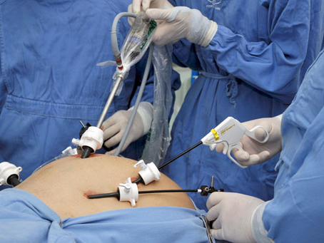 O que é videolaparoscopia?