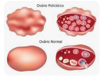 Síndrome de ovários policísticos