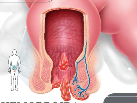 Hemorroida e a idade avançada
