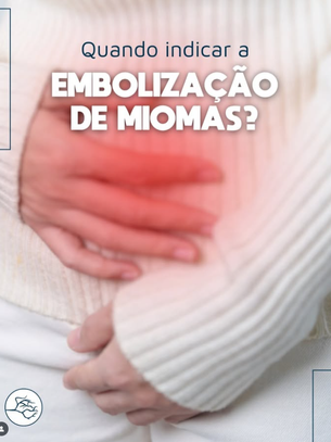 Embolização de miomas