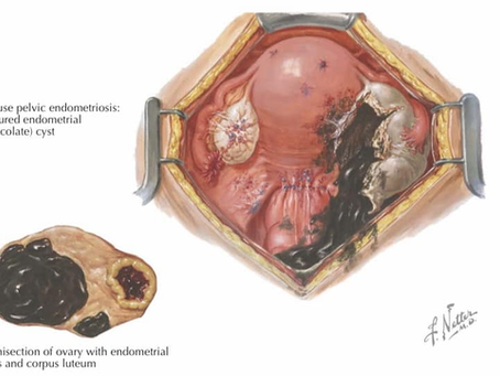 Endometriomas Ovarianos: Compreenda os Sintomas, Diagnóstico e Tratamento