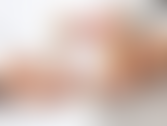 Tumor de Cólon (Câncer de cólon e reto)