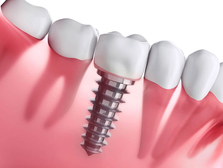 O QUE É UM IMPLANTE DENTÁRIO?