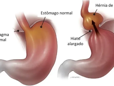 Hérnia de Hiato