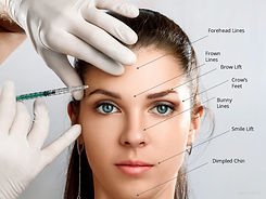 enhancedaesthetics botox areas.jpeg
