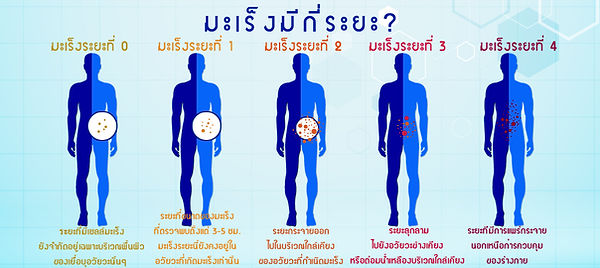 ระยะของมะเร็ง.jpg