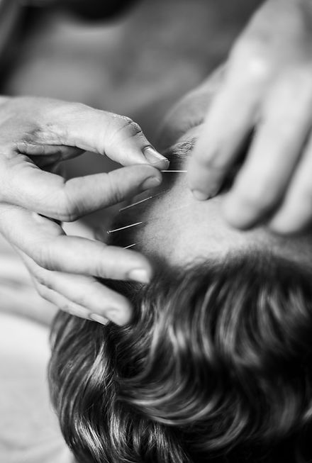 דיקור בפנים להעלמת קמטים