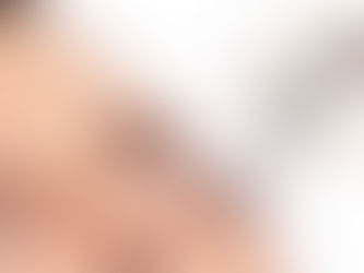 Unlocking Radiant Skin with MiraPeel: The Ultimate Hydradermabrasion and Wet Microneedling Treatment in La Jolla, San Diego