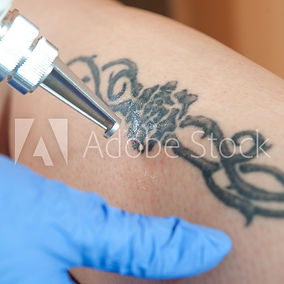 Tattooentfernung