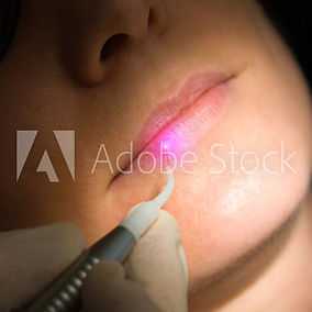 Lasertherapie