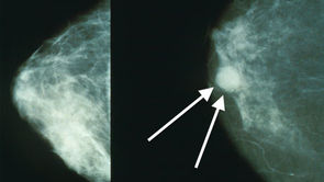 Bariatric surgery may reduce the overall risk of breast cancer in women with obesity