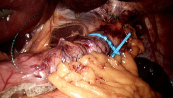 IFSO ‘cautiously’ supports the selective use of ring augmentation in both primary and revisional MBS