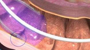 Duodenal mucosal resurfacing may prevent weight recurrence following GLP-1 discontinuation