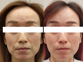 食いしばるとエラが張って顔がデカくなる