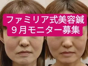 9月度美容鍼モニター募集！