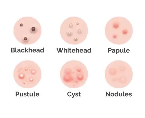 Ance Types Blackheads, whiteheads, pustule, cyst, nodules