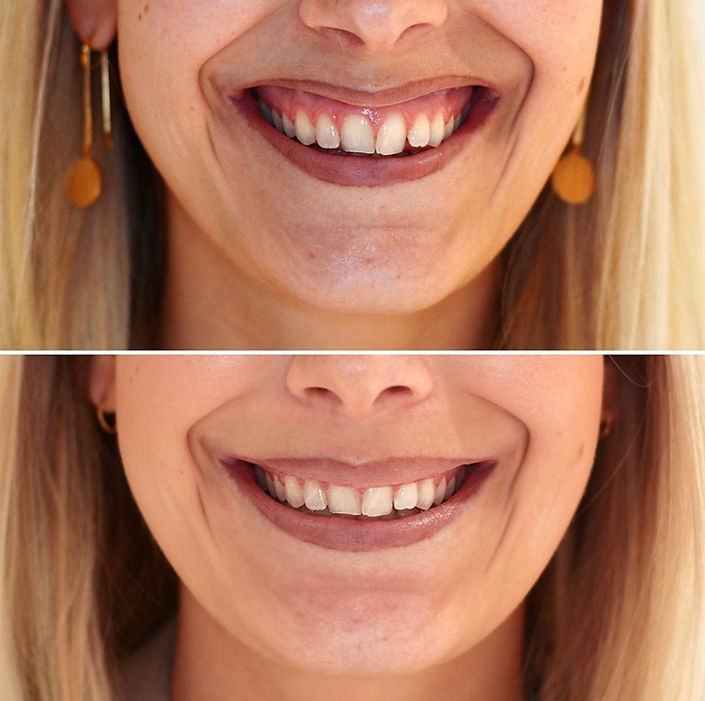 gummy smile tandkött botox behandling före efter bild på göta hudklinik i göteborg, sverige