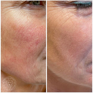 Rosacea ytliga kärl före efter bild IPL i Göteborg på Göta Hudklinik