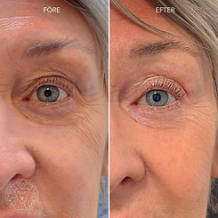 före efter bild på rynkor runt ögonen efter en rf-behandling med radio frekvens och microneedling på göta hudklinik