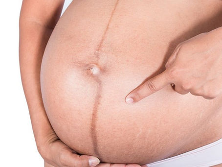 5 tips to prevent dark skin in pregnancy