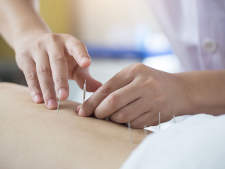Debunk 3 Myths of TCM Acupuncture