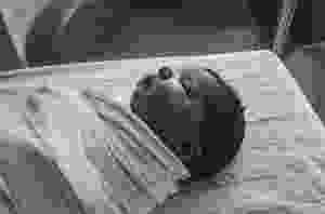 Pregnancy Singapore: Cesarean section delivery