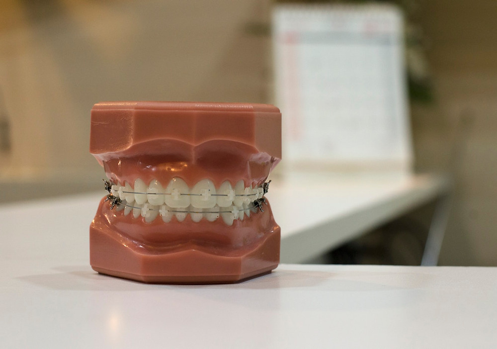 Pregnancy Singapore: Braces in pregnancy