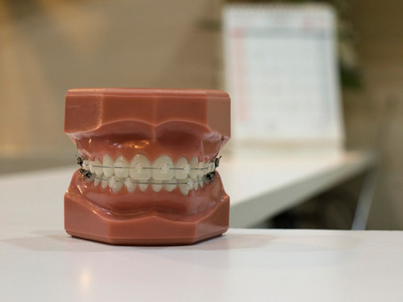 Braces in pregnancy