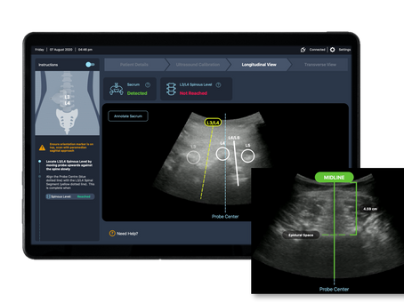 Ultrasound and AI transform epidural pain relief during labour
