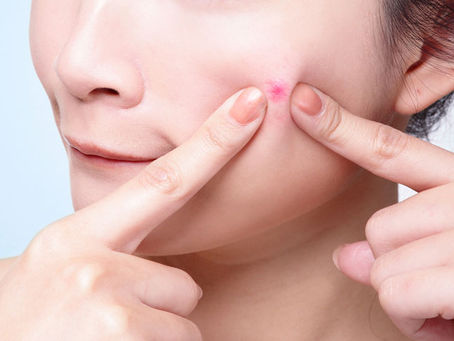 Pregnancy acne - you are not alone