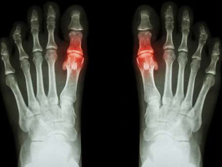 Homeopathy and Supplements for Gout