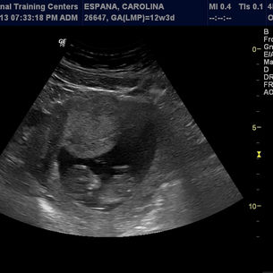 Embarazo y Parto.....Cambios Hormonales....