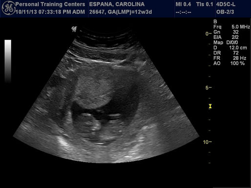 Embarazo y Parto.....Cambios Hormonales....