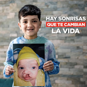 Smile Train lanza campaña en Chile para tratamiento gratuito de niños con fisura labio palatina