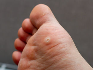 What to do about a Wart?