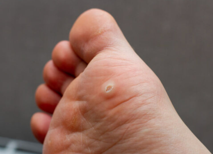 What to do about a Wart?