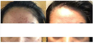 Non-Invasive Microneedling
