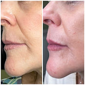Before and After Smile Lines
