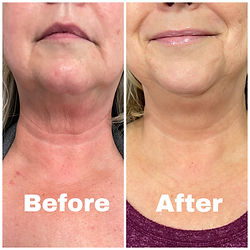 Before and After of neck area
