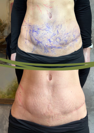 zakryvani jizvy po abdominoplastice bricha Tattoo Mija 